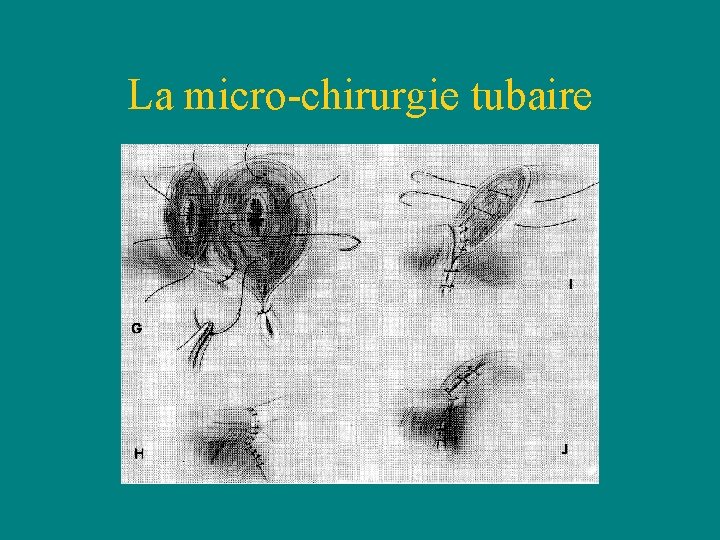 La micro-chirurgie tubaire La micro-chirurgie tubaire