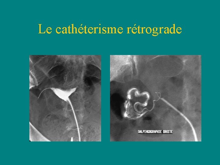 Le cathéterisme rétrograde Le cathéterisme rétrograde