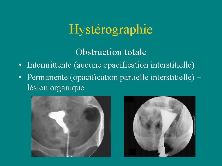 Hystérographie Obstruction totale • Intermittente (aucune opacification interstitielle) • Permanente (opacification partielle interstitielle) = Hystérographie Obstruction totale • Intermittente (aucune opacification interstitielle) • Permanente (opacification partielle interstitielle) =
