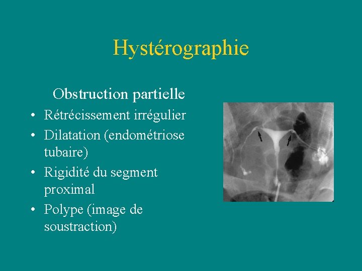 Hystérographie Obstruction partielle • Rétrécissement irrégulier • Dilatation (endométriose tubaire) • Rigidité du segment Hystérographie Obstruction partielle • Rétrécissement irrégulier • Dilatation (endométriose tubaire) • Rigidité du segment