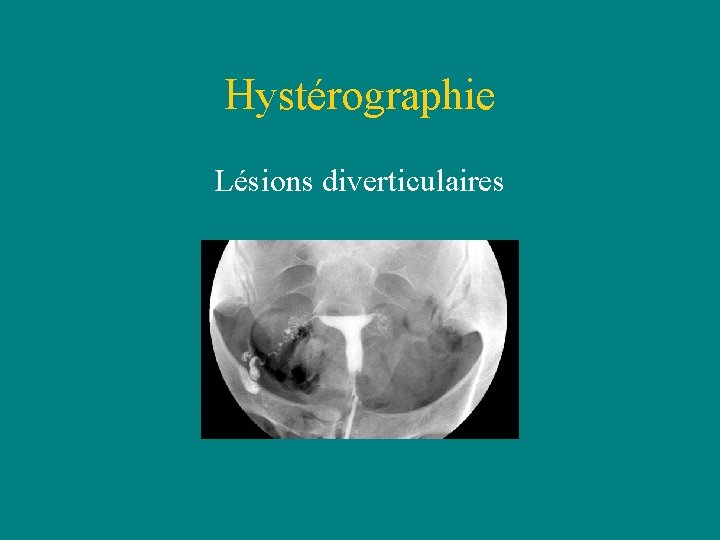 Hystérographie Lésions diverticulaires Hystérographie Lésions diverticulaires