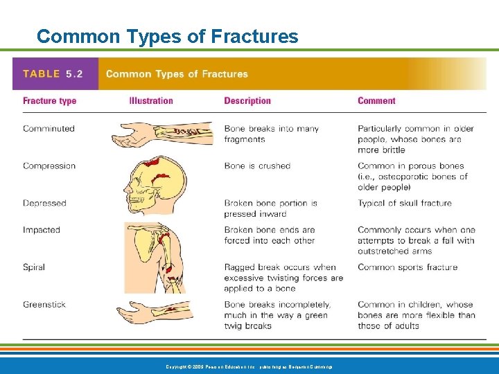 Common Types of Fractures Table 5. 2 Copyright © 2009 Pearson Education, Inc. , Common Types of Fractures Table 5. 2 Copyright © 2009 Pearson Education, Inc. ,