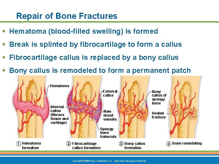 Repair of Bone Fractures § Hematoma (blood-filled swelling) is formed § Break is splinted Repair of Bone Fractures § Hematoma (blood-filled swelling) is formed § Break is splinted