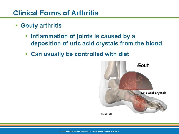 Clinical Forms of Arthritis § Gouty arthritis § Inflammation of joints is caused by Clinical Forms of Arthritis § Gouty arthritis § Inflammation of joints is caused by