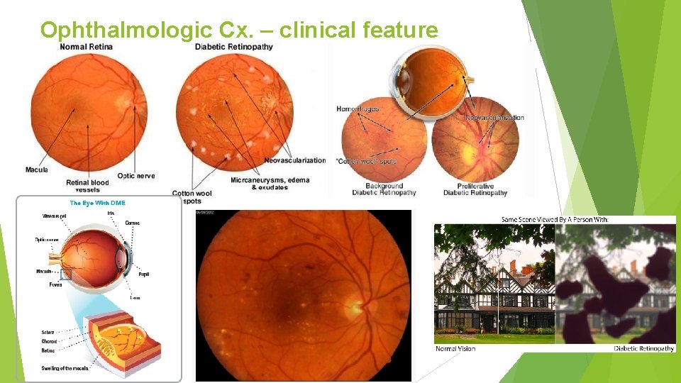 Ophthalmologic Cx. – clinical feature 