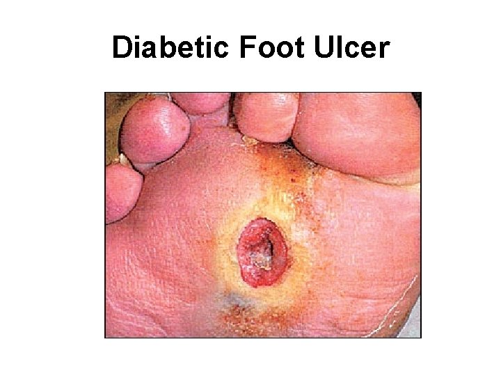 Diabetic Foot Ulcer 