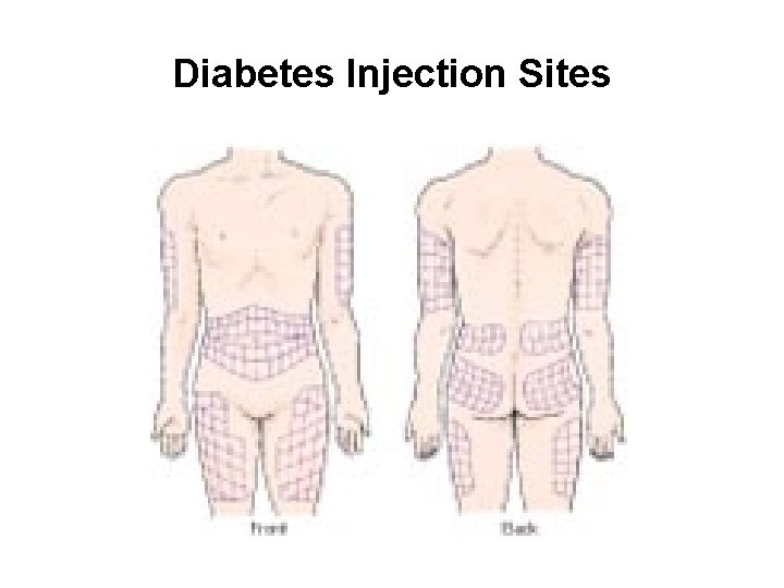 Diabetes Injection Sites 