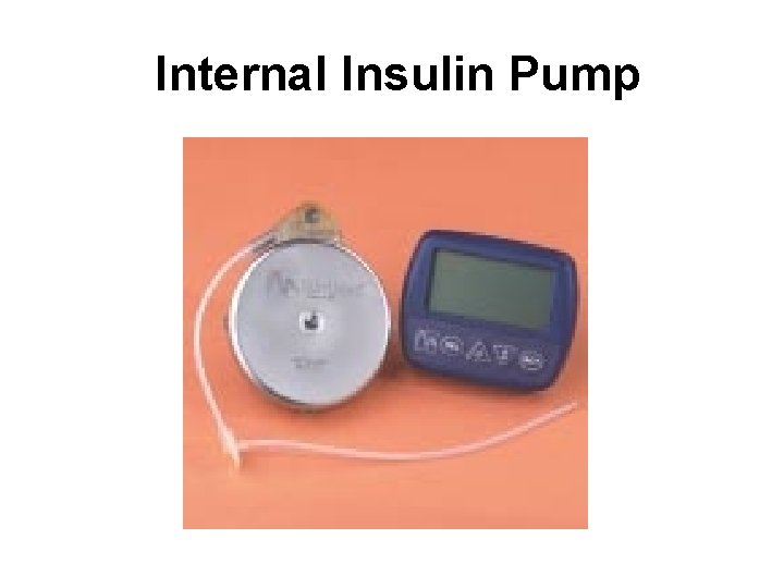 Internal Insulin Pump 