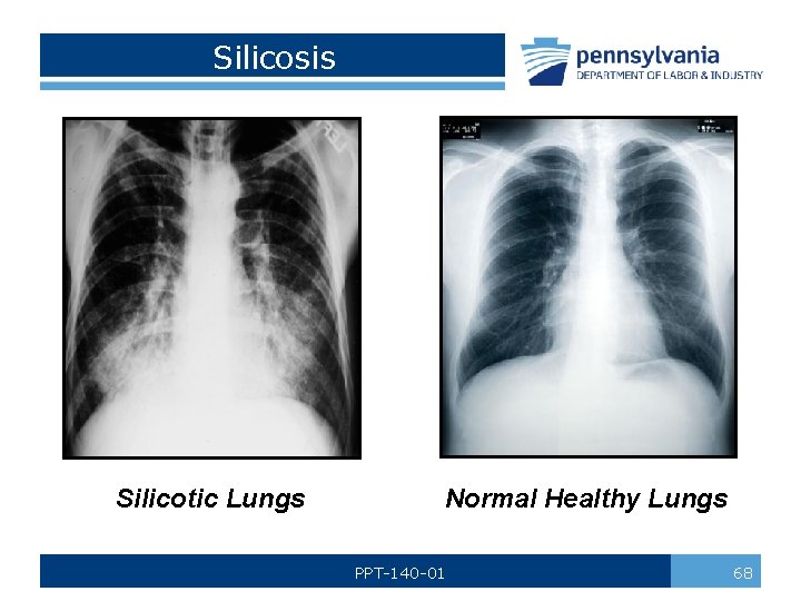 Silicosis Silicotic Lungs Normal Healthy Lungs PPT-140 -01 68 