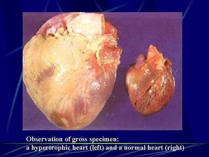 Observation of gross specimen: a hypertrophic heart (left) and a normal heart (right) 