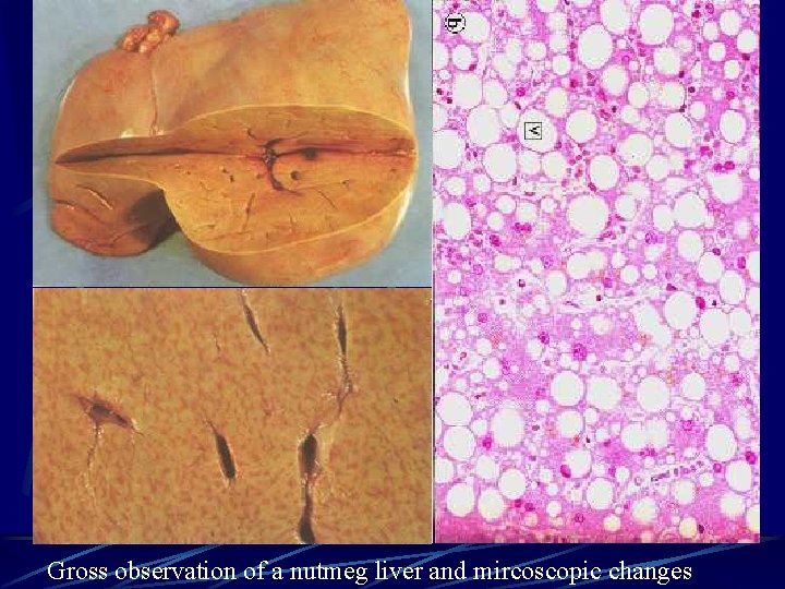 Gross observation of a nutmeg liver and mircoscopic changes 