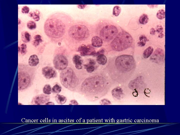 Cancer cells in ascites of a patient with gastric carcinoma 