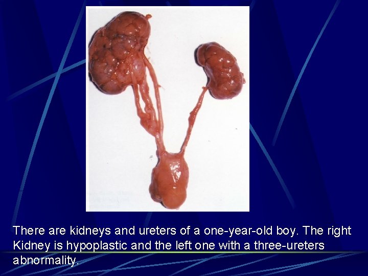 There are kidneys and ureters of a one-year-old boy. The right Kidney is hypoplastic