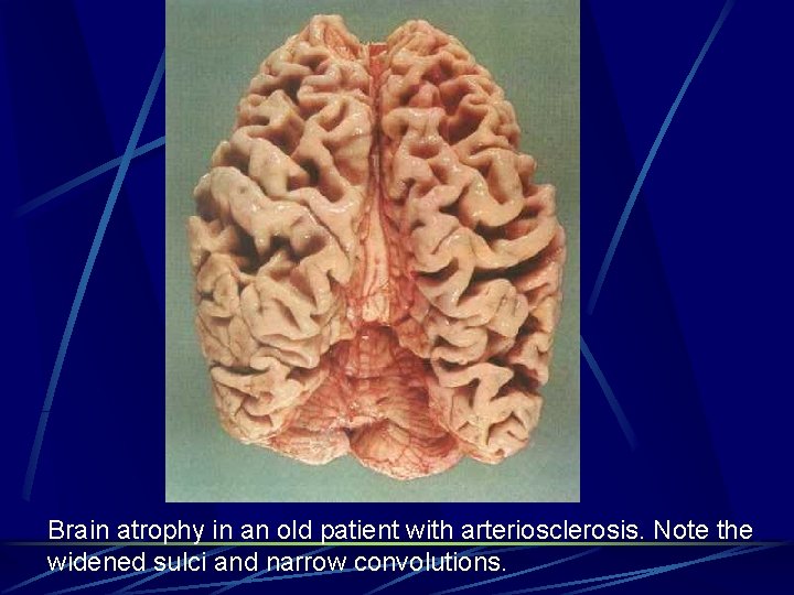 Brain atrophy in an old patient with arteriosclerosis. Note the widened sulci and narrow