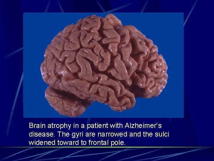 Brain atrophy in a patient with Alzheimer’s disease. The gyri are narrowed and the