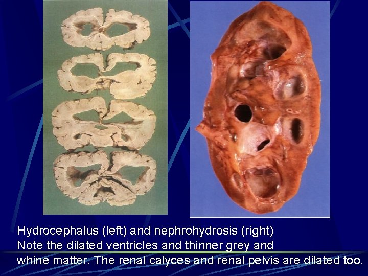 Hydrocephalus (left) and nephrohydrosis (right) Note the dilated ventricles and thinner grey and whine