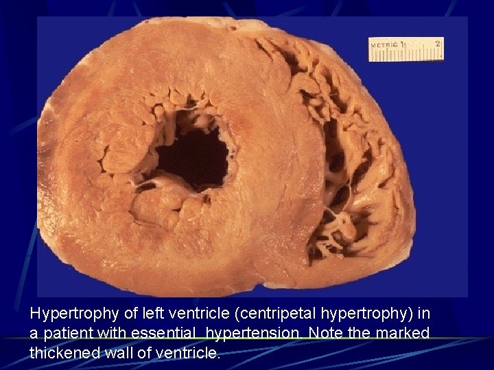 Hypertrophy of left ventricle (centripetal hypertrophy) in a patient with essential hypertension. Note the