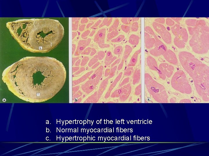 a. Hypertrophy of the left ventricle b. Normal myocardial fibers c. Hypertrophic myocardial fibers