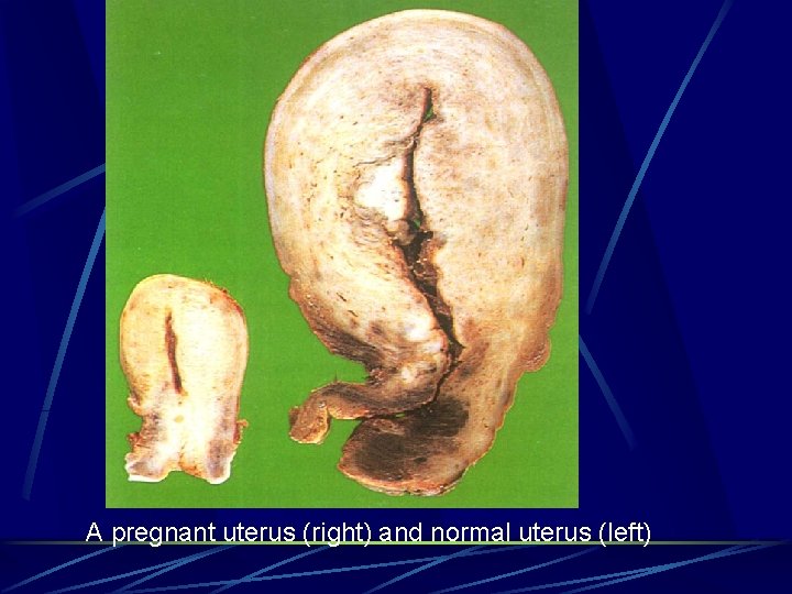 A pregnant uterus (right) and normal uterus (left) 