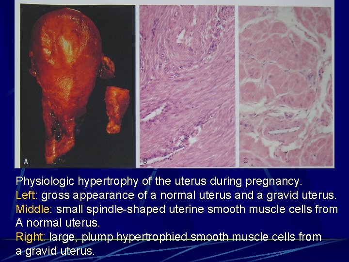 Physiologic hypertrophy of the uterus during pregnancy. Left: gross appearance of a normal uterus