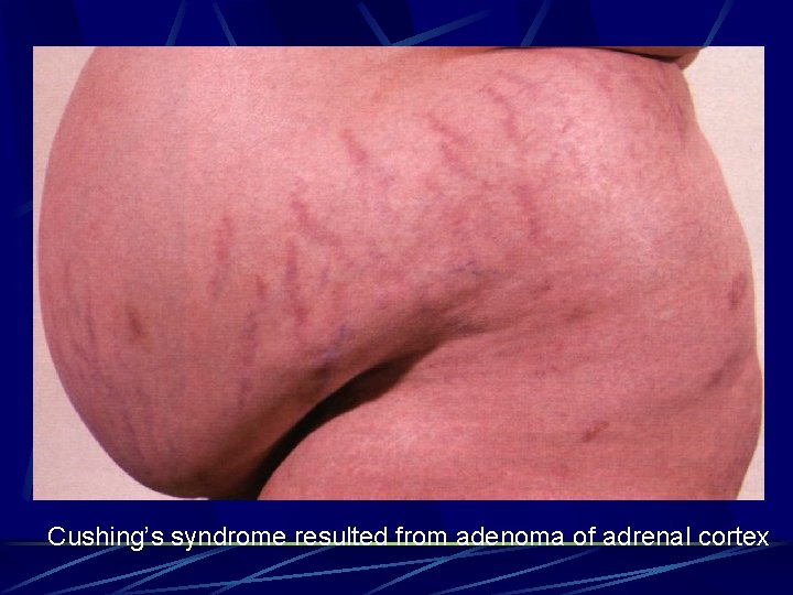 Cushing’s syndrome resulted from adenoma of adrenal cortex 