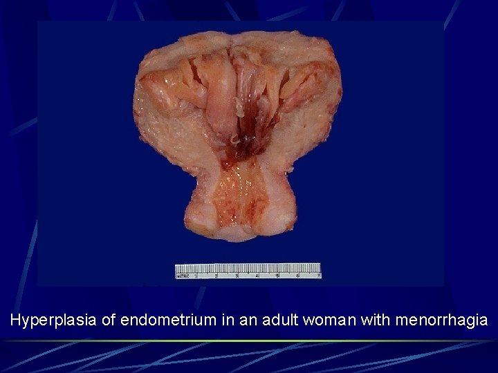 Hyperplasia of endometrium in an adult woman with menorrhagia 