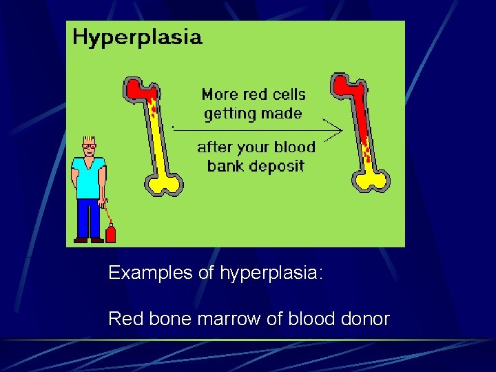 Examples of hyperplasia: Red bone marrow of blood donor 