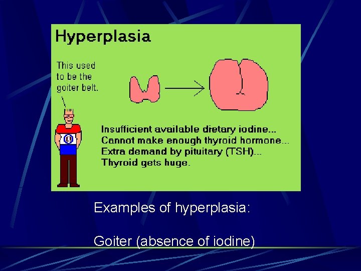 Examples of hyperplasia: Goiter (absence of iodine) 