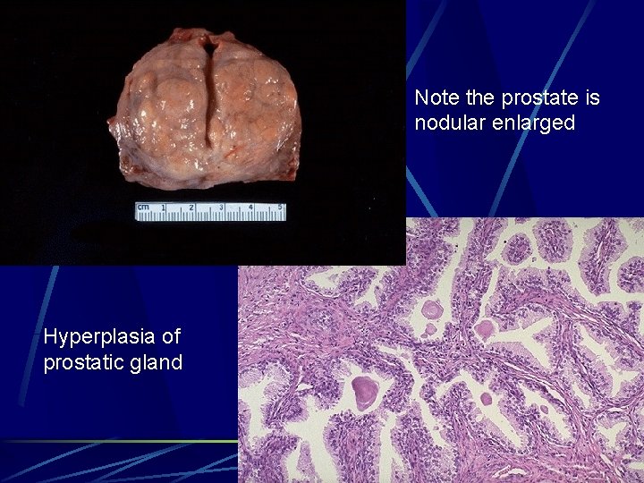 Note the prostate is nodular enlarged Hyperplasia of prostatic gland 