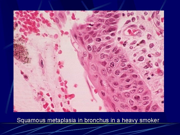 Squamous metaplasia in bronchus in a heavy smoker 