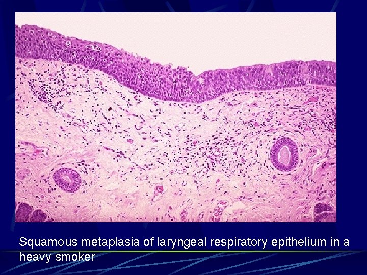 Squamous metaplasia of laryngeal respiratory epithelium in a heavy smoker 