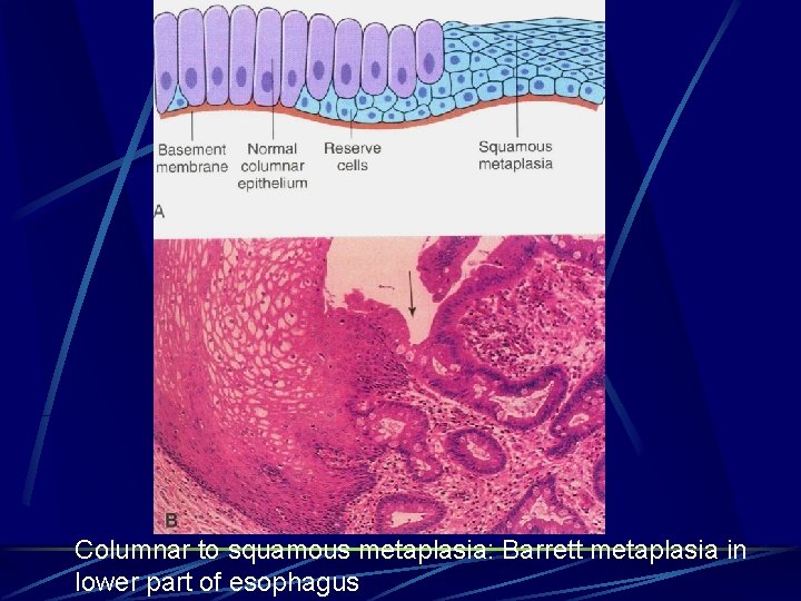 Columnar to squamous metaplasia: Barrett metaplasia in lower part of esophagus 