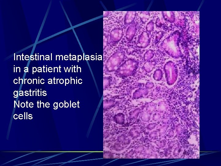 Intestinal metaplasia in a patient with chronic atrophic gastritis Note the goblet cells 