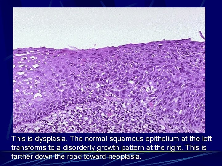 This is dysplasia. The normal squamous epithelium at the left transforms to a disorderly