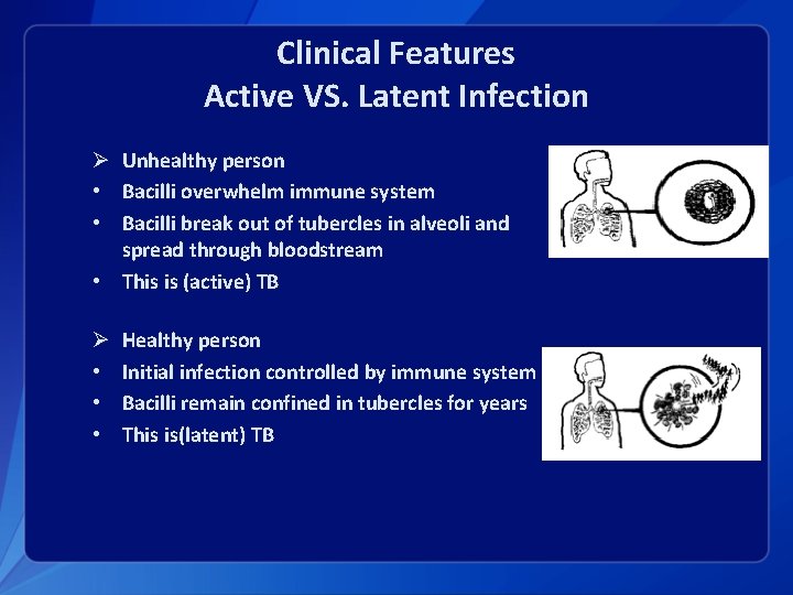 Clinical Features Active VS. Latent Infection Ø Unhealthy person • Bacilli overwhelm immune system