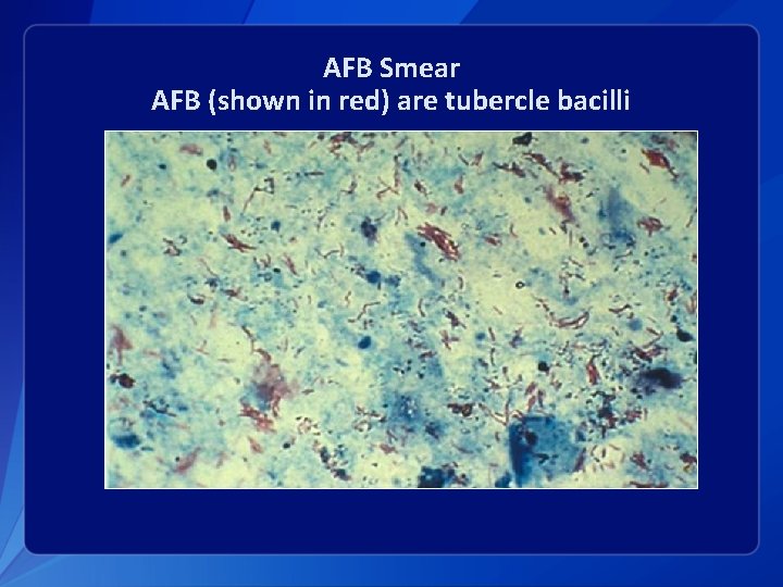 AFB Smear AFB (shown in red) are tubercle bacilli 