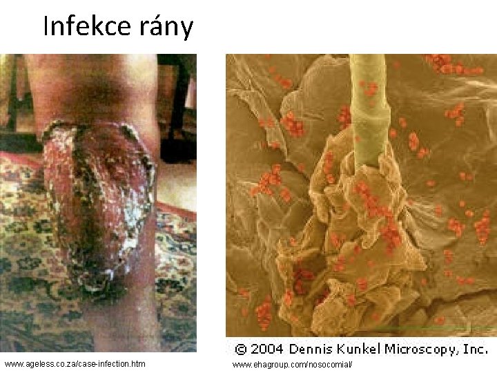 Infekce rány www. ageless. co. za/case-infection. htm www. ehagroup. com/nosocomial/ Infekce rány www. ageless. co. za/case-infection. htm www. ehagroup. com/nosocomial/