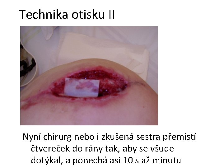 Technika otisku II Nyní chirurg nebo i zkušená sestra přemístí čtvereček do rány tak, Technika otisku II Nyní chirurg nebo i zkušená sestra přemístí čtvereček do rány tak,