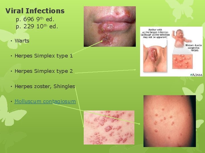 Viral Infections p. 696 9 th ed. p. 229 10 th ed. • Warts