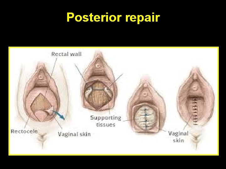 Posterior repair 