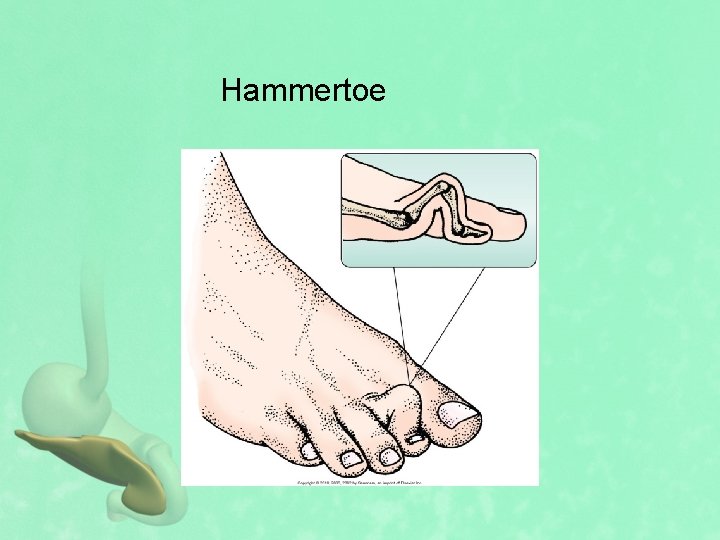 Hammertoe 