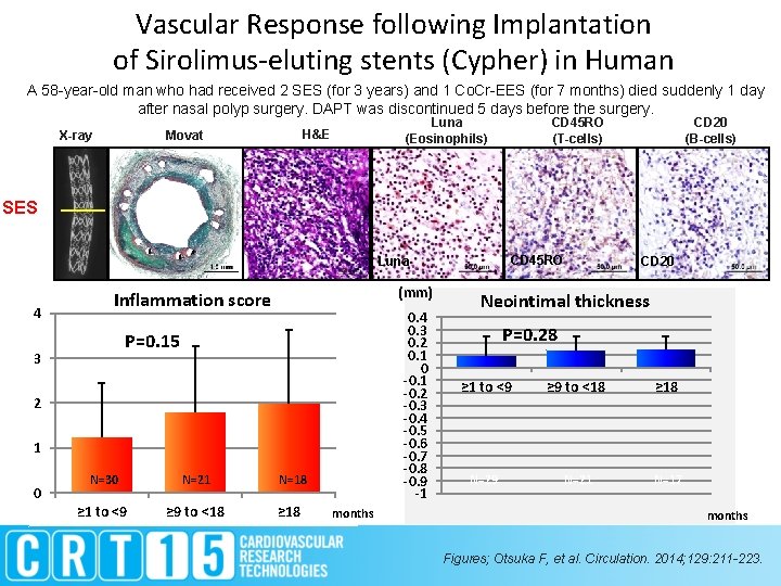 Vascular Response following Implantation of Sirolimus-eluting stents (Cypher) in Human A 58 -year-old man