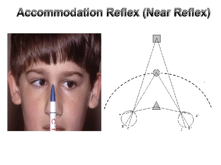 Accommodation Reflex (Near Reflex) 