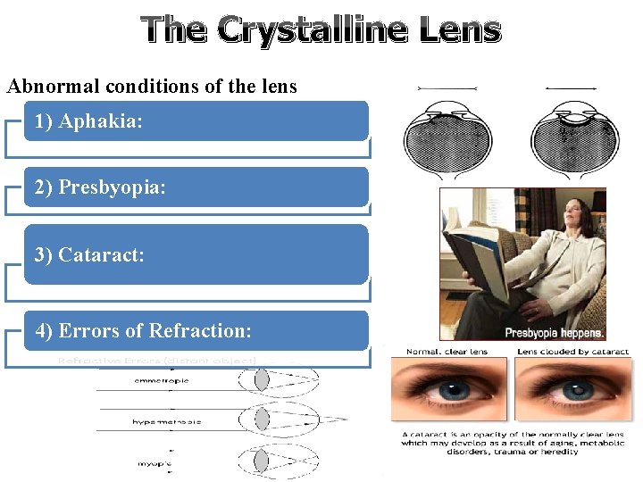 The Crystalline Lens Abnormal conditions of the lens 1) Aphakia: 2) Presbyopia: 3) Cataract: