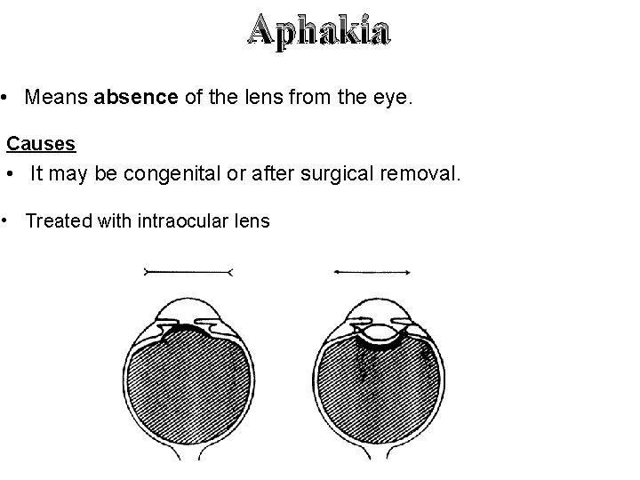 Aphakia • Means absence of the lens from the eye. Causes • It may