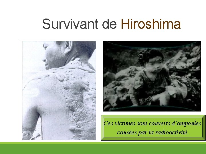 Survivant de Hiroshima Ces victimes sont couverts d’ampoules causées par la radioactivité. 