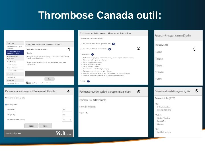 Thrombose Canada outil: 1 2 4 5 3 6 