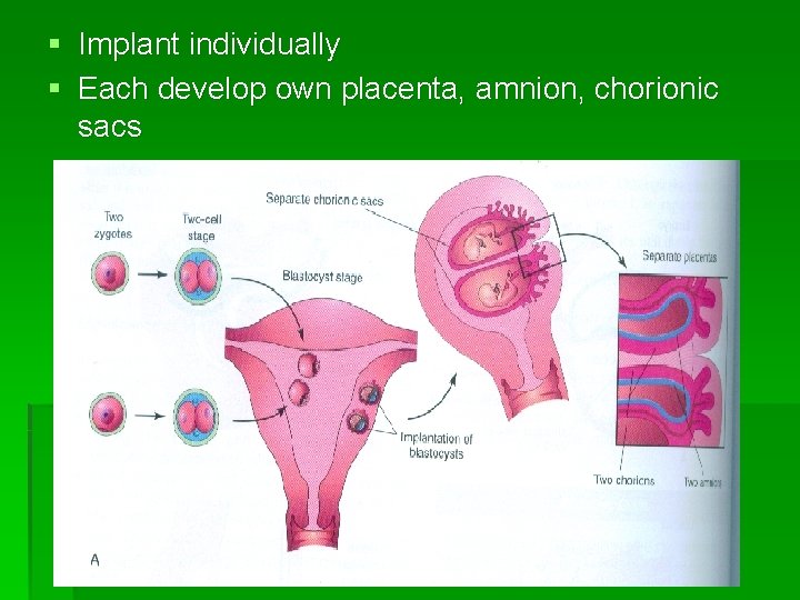 § Implant individually § Each develop own placenta, amnion, chorionic sacs 