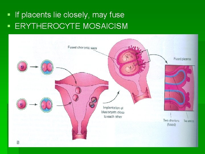 § If placents lie closely, may fuse § ERYTHEROCYTE MOSAICISM 