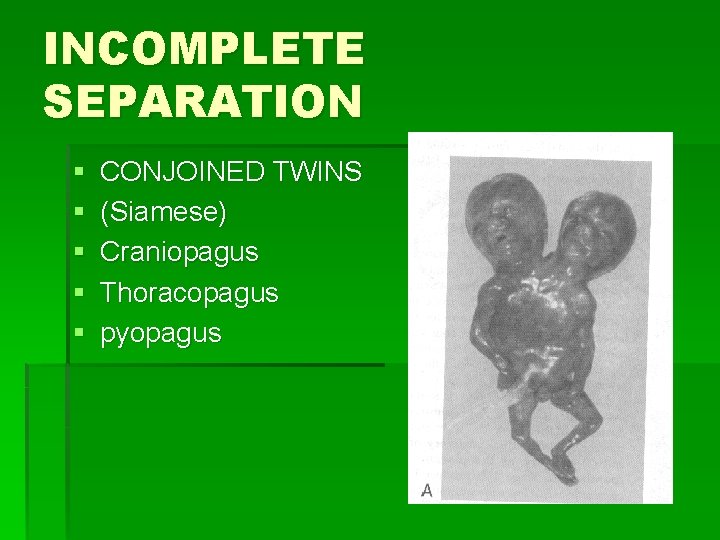 INCOMPLETE SEPARATION § § § CONJOINED TWINS (Siamese) Craniopagus Thoracopagus pyopagus 